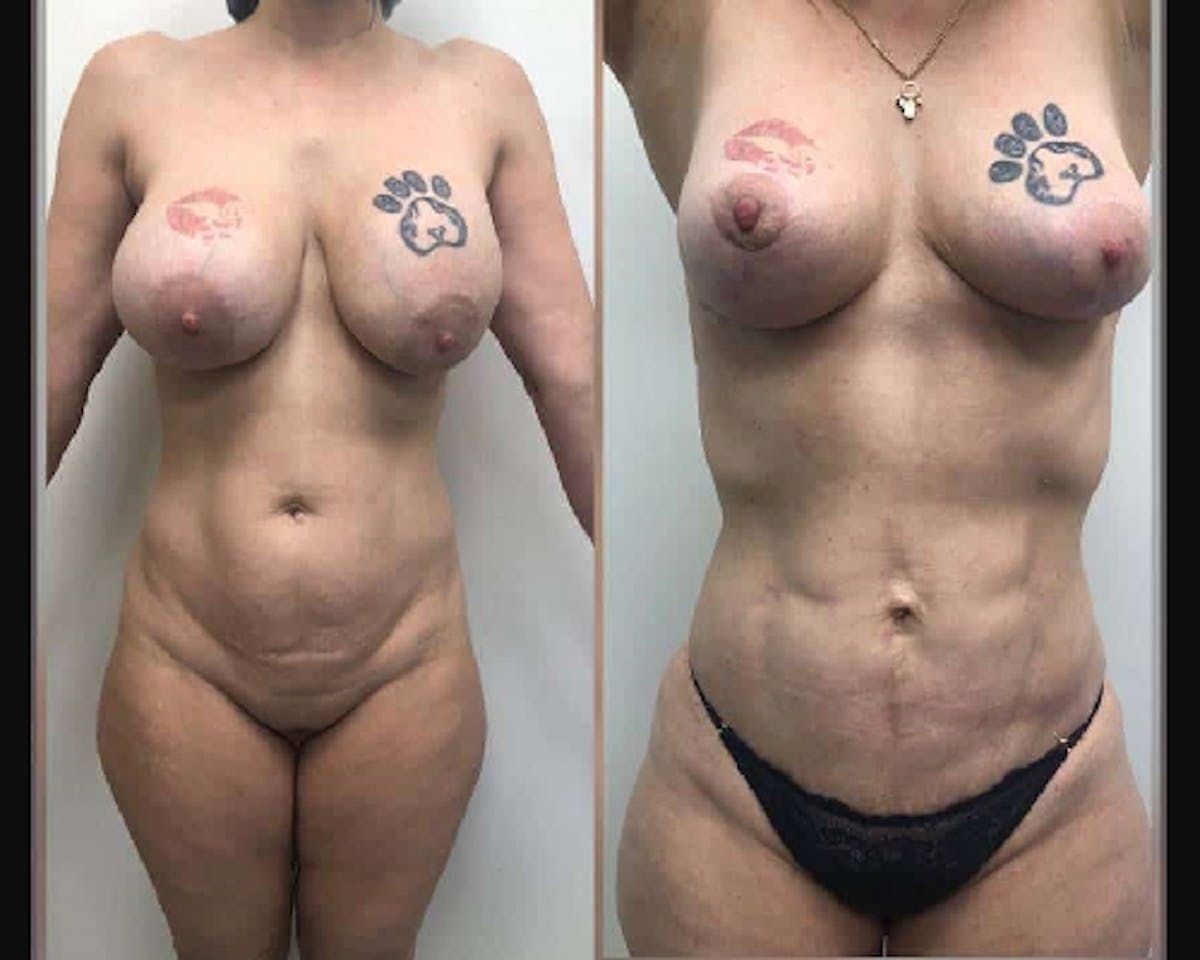 Liposuction Before & After Gallery - Patient 130999 - Image 1