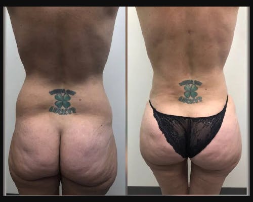 Liposuction Before & After Gallery - Patient 130999 - Image 2