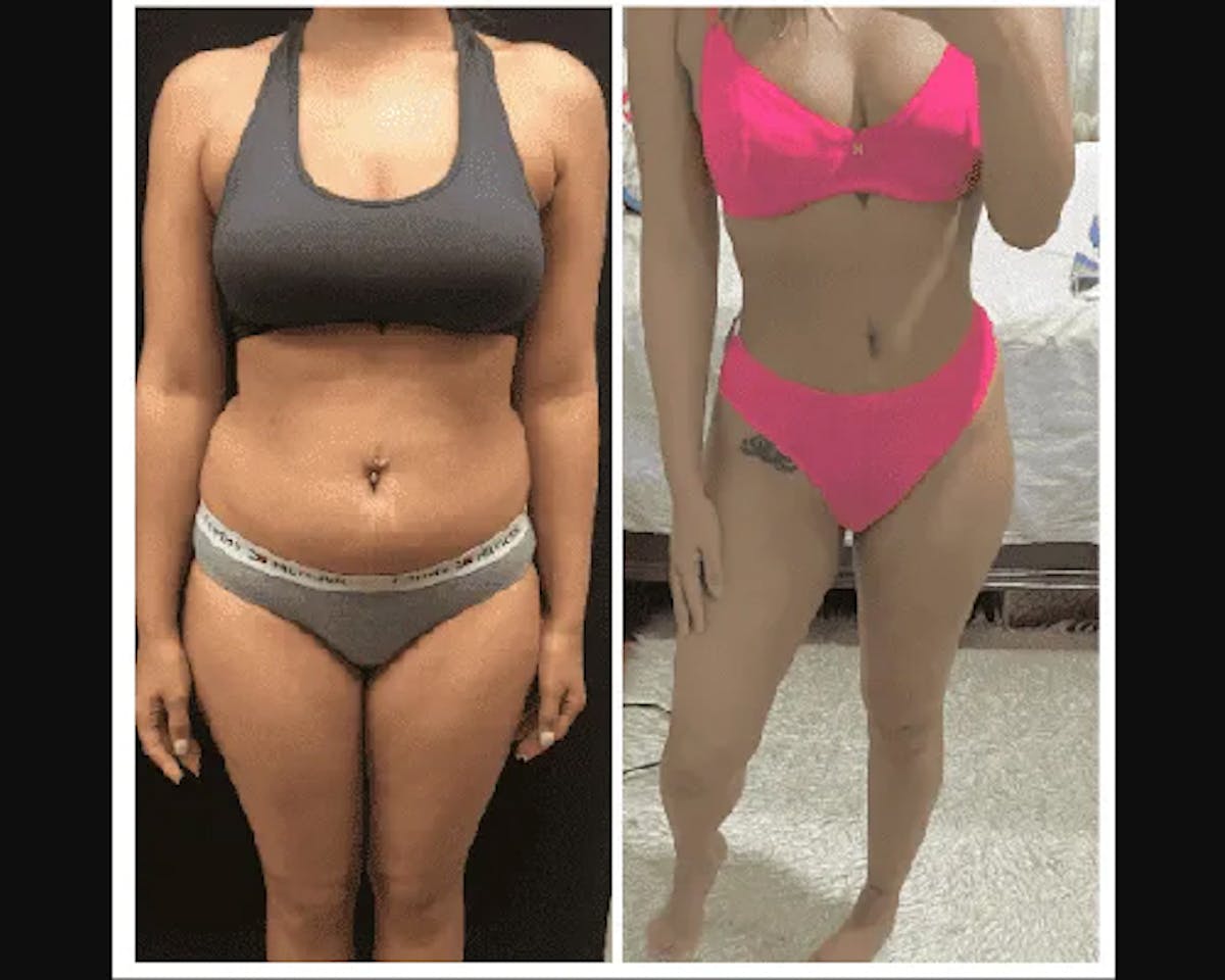 Liposuction Before & After Gallery - Patient 404875 - Image 1