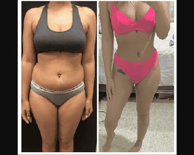Liposuction Before & After Gallery - Patient 404875 - Image 1