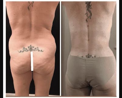 Liposuction Before & After Gallery - Patient 973552 - Image 1