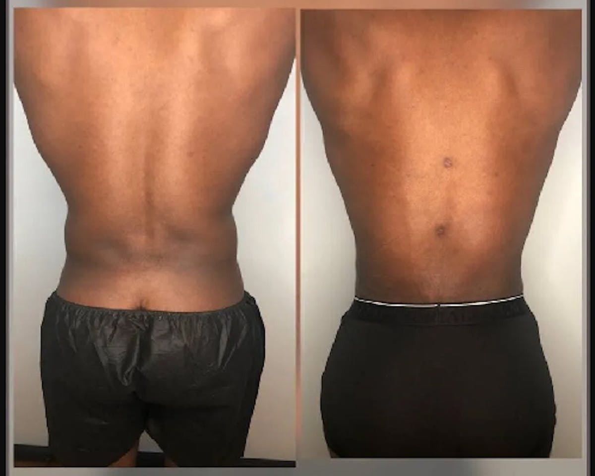 Liposuction Under Local Before & After Gallery - Patient 306556 - Image 1
