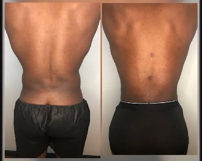 Liposuction Under Local Before & After Gallery - Patient 306556 - Image 1