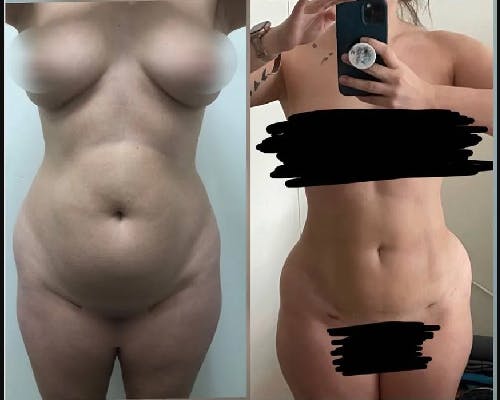 Liposuction Under Local Before & After Gallery - Patient 342479 - Image 1