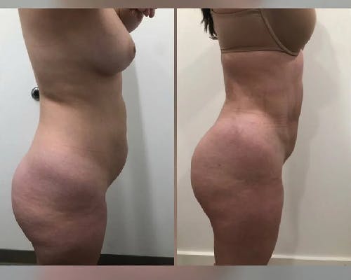 Liposuction Under Local Before & After Gallery - Patient 342479 - Image 2