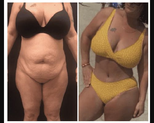 Mommy Makeover Before & After Gallery - Patient 285899 - Image 1