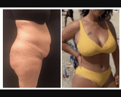 Mommy Makeover Before & After Gallery - Patient 285899 - Image 2