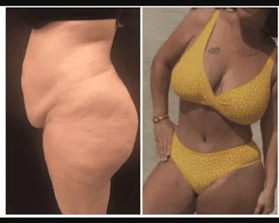 Mommy Makeover Before & After Gallery - Patient 285899 - Image 3