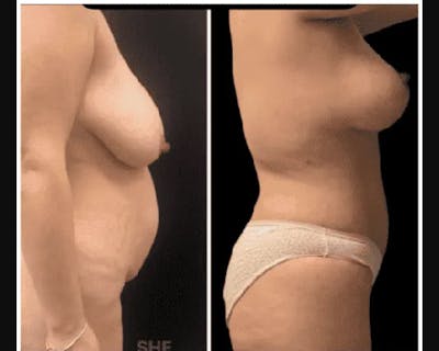 Mommy Makeover Before & After Gallery - Patient 283569 - Image 1