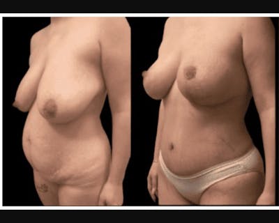 Mommy Makeover Before & After Gallery - Patient 283569 - Image 2