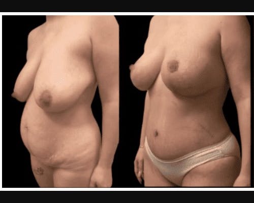 Mommy Makeover Before & After Gallery - Patient 283569 - Image 2