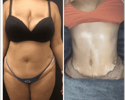 Mommy Makeover Before & After Gallery - Patient 282814 - Image 1