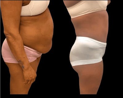 Mommy Makeover Before & After Gallery - Patient 311401 - Image 1