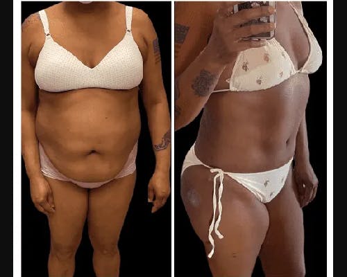 Mommy Makeover Before & After Gallery - Patient 311401 - Image 2