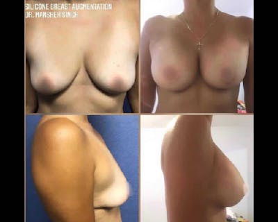 Breast Augmentation Before & After Gallery - Patient 118207 - Image 1