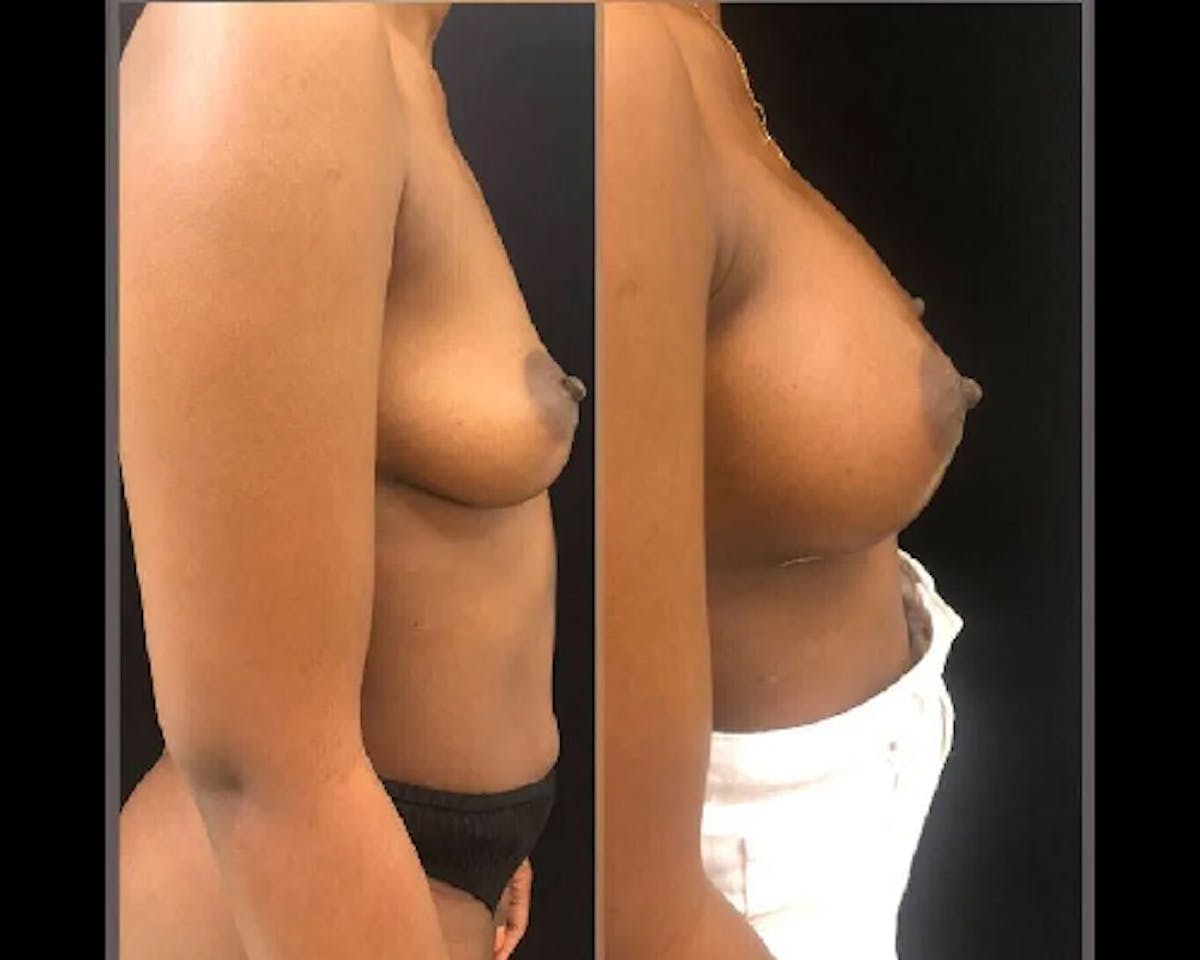  Breast Augmentation Before & After Gallery - Patient 292204 - Image 2