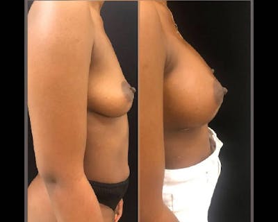 Breast Augmentation Before & After Gallery - Patient 292204 - Image 2
