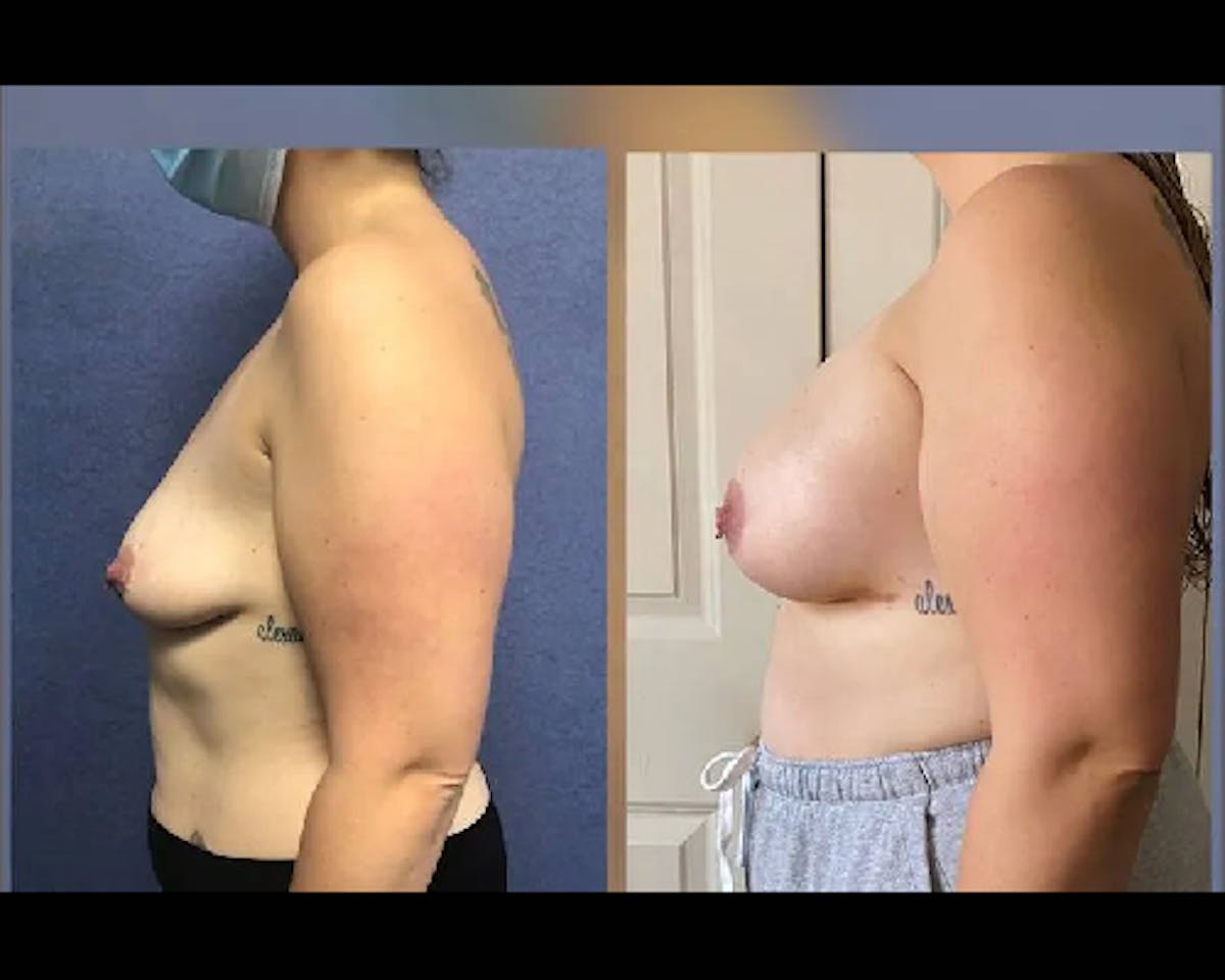  Breast Augmentation Before & After Gallery - Patient 291707 - Image 1