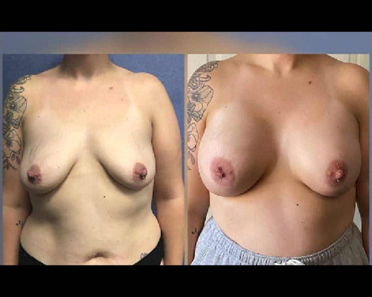  Breast Augmentation Before & After Gallery - Patient 291707 - Image 2