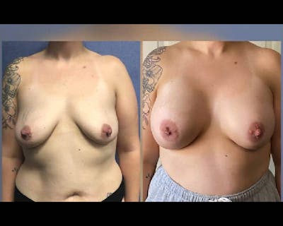 Breast Augmentation Before & After Gallery - Patient 291707 - Image 2