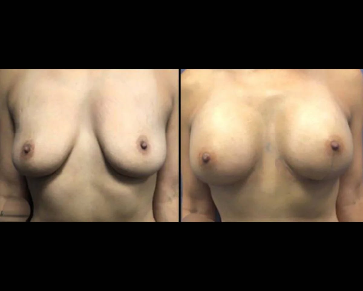  Breast Augmentation Before & After Gallery - Patient 826482 - Image 1