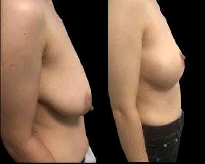 Breast Lift Before & After Gallery - Patient 296470 - Image 1