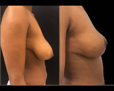 Breast Lift Before & After Gallery - Patient 304259 - Image 1