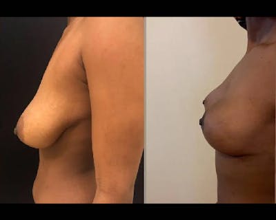 Breast Lift Before & After Gallery - Patient 304259 - Image 2