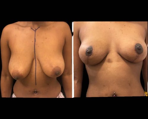 Breast Lift Before & After Gallery - Patient 304259 - Image 3