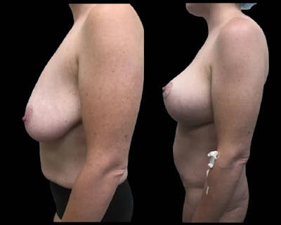 Breast Lift with Augmentation Before & After Gallery - Patient 334519 - Image 2