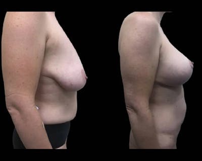 Breast Lift with Augmentation Before & After Gallery - Patient 334519 - Image 3
