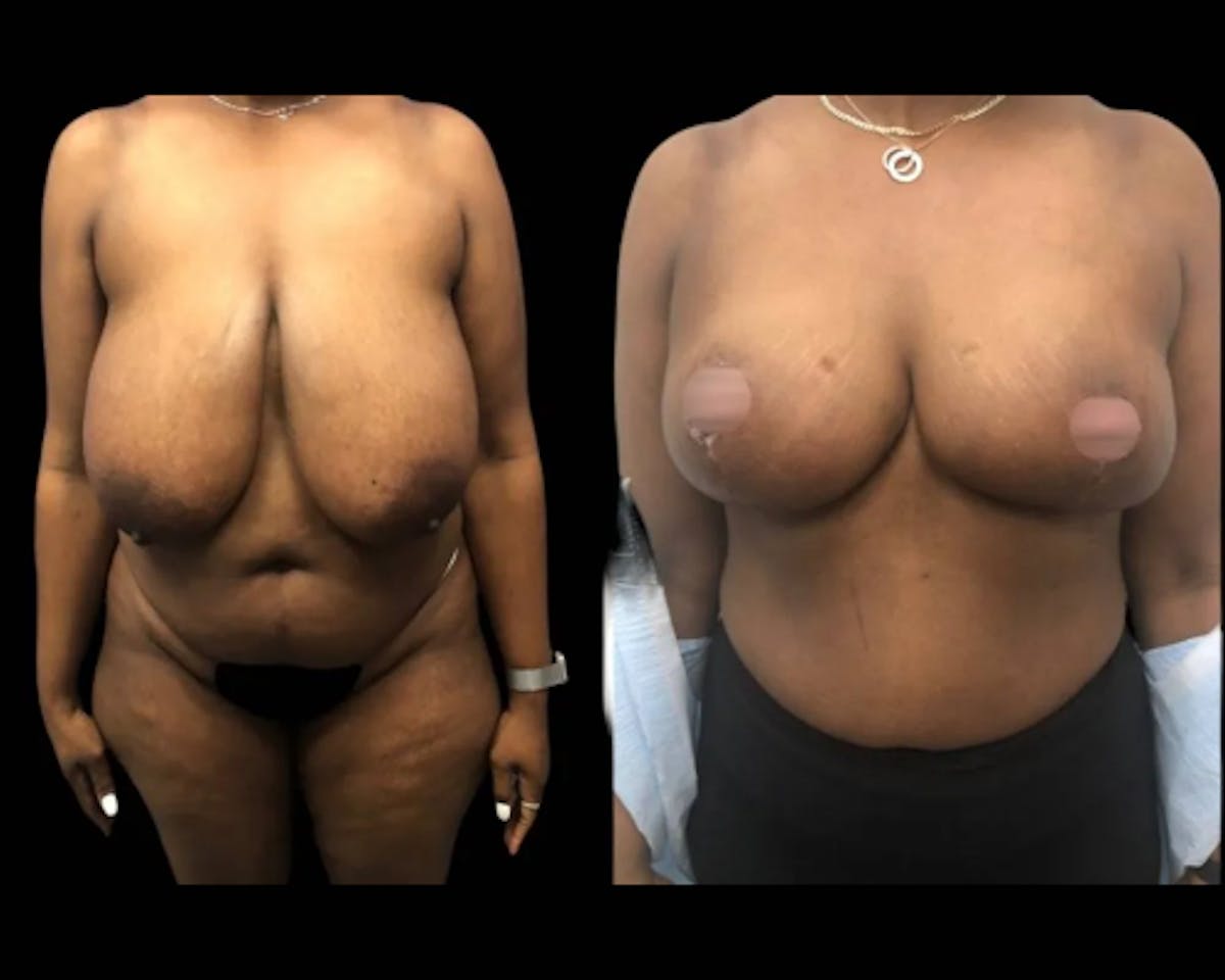 Breast Reduction Before & After Gallery - Patient 364285 - Image 1