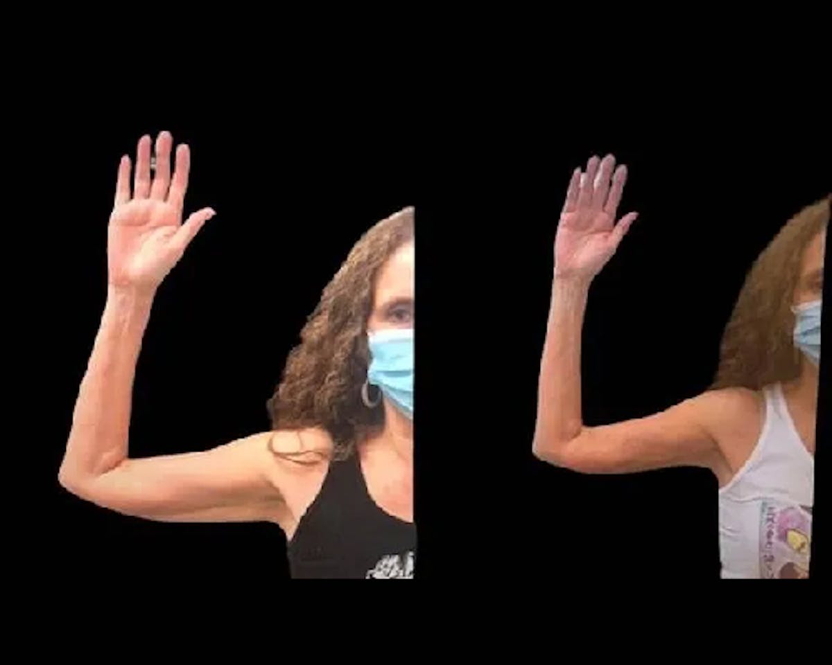  Bodytite Before & After Gallery - Patient 191978 - Image 1