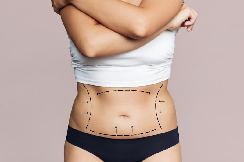 woman's abdominal area with lines drawn on it before tummy tuck surgery