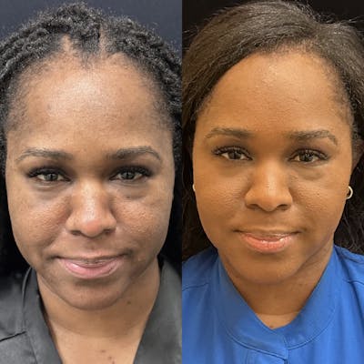 Buccal Fat Reduction Before & After Gallery - Patient 206644 - Image 1