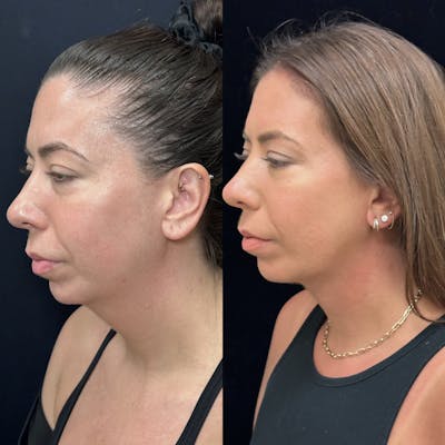 Necklift Before & After Gallery - Patient 983479 - Image 3