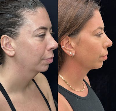 Necklift Before & After Gallery - Patient 983479 - Image 4