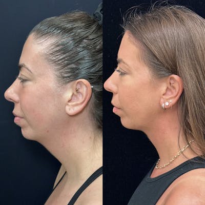 Necklift Before & After Gallery - Patient 983479 - Image 2