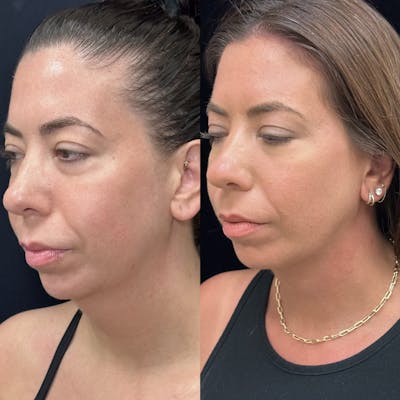 Necklift Before & After Gallery - Patient 983479 - Image 1