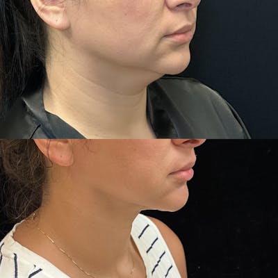 Chin & Neck Lipo Sculpting Before & After Gallery - Patient 724522 - Image 4