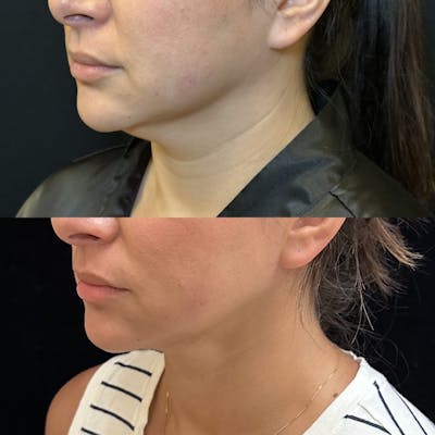 Chin & Neck Lipo Sculpting Before & After Gallery - Patient 724522 - Image 3