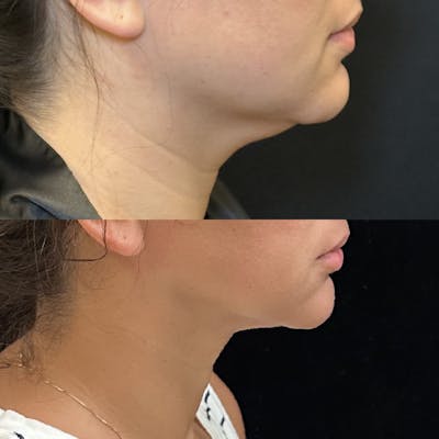 Chin & Neck Lipo Sculpting Before & After Gallery - Patient 724522 - Image 1