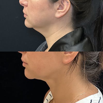Chin & Neck Lipo Sculpting Before & After Gallery - Patient 724522 - Image 2