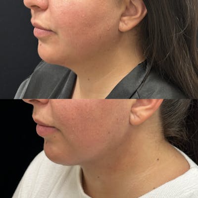 Chin & Neck Lipo Sculpting Before & After Gallery - Patient 145005 - Image 4