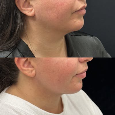 Chin & Neck Lipo Sculpting Before & After Gallery - Patient 145005 - Image 3