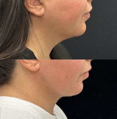 Chin & Neck Lipo Sculpting Before & After Gallery - Patient 145005 - Image 2