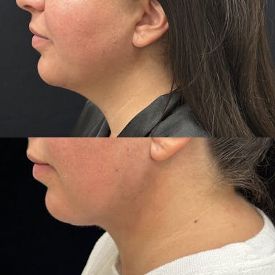 Chin & Neck Lipo Sculpting Before & After Gallery - Patient 145005 - Image 1