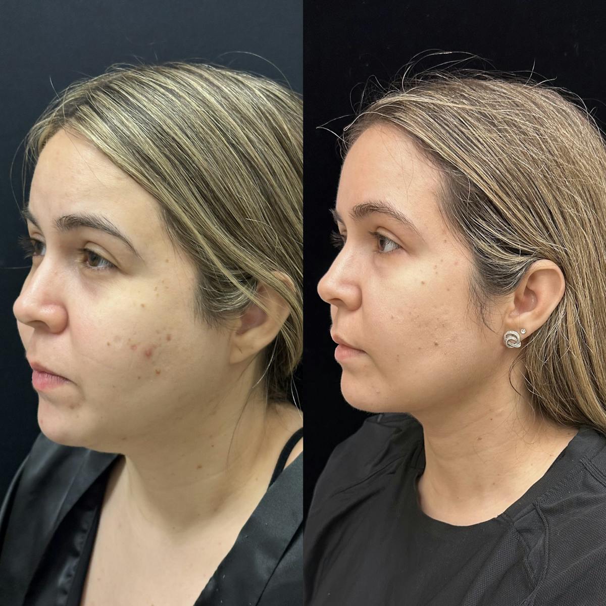 Buccal Fat Reduction Before & After Gallery - Patient 264180 - Image 1