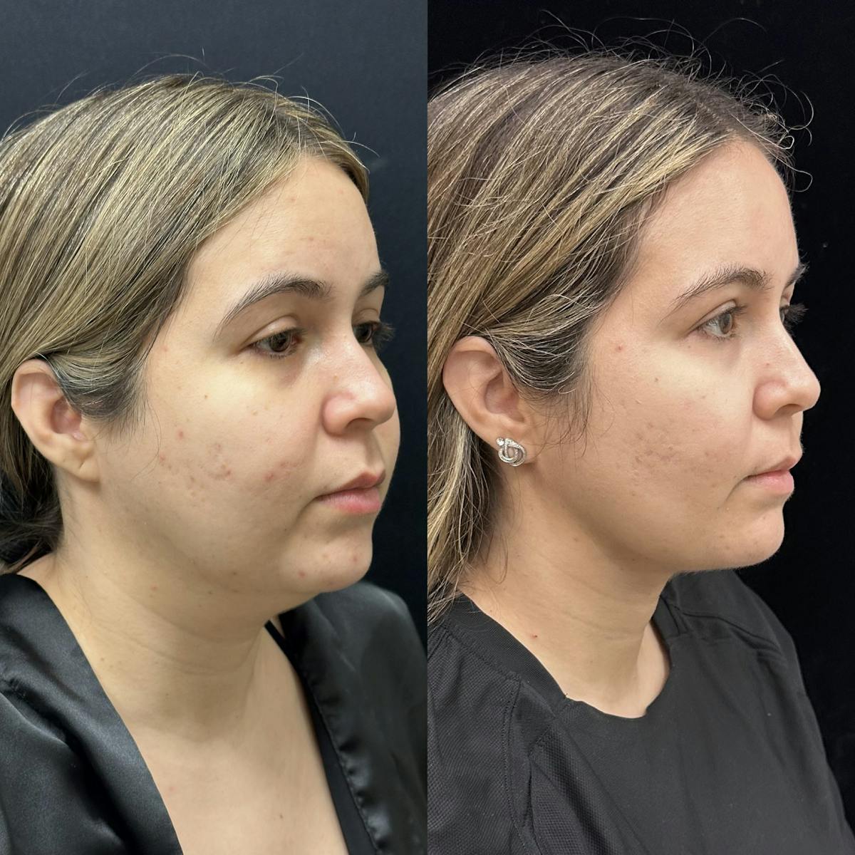 Buccal Fat Reduction Before & After Gallery - Patient 264180 - Image 3