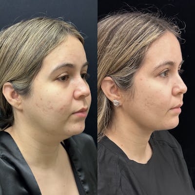 Buccal Fat Reduction Before & After Gallery - Patient 264180 - Image 3
